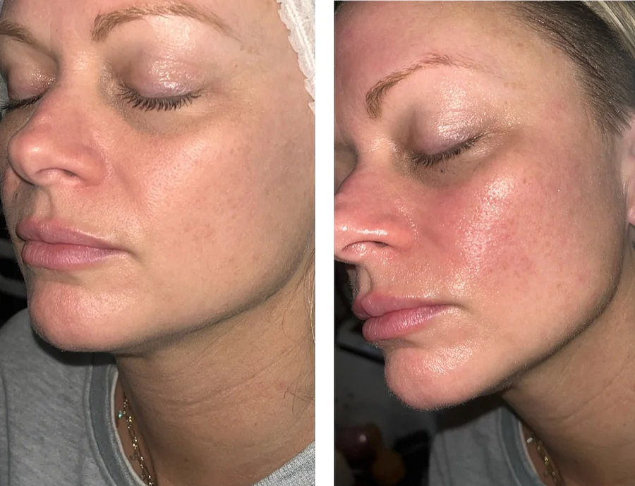 Before and after Red Carpet RF Facial at Perfections Body Sculpt, Rowlett TX