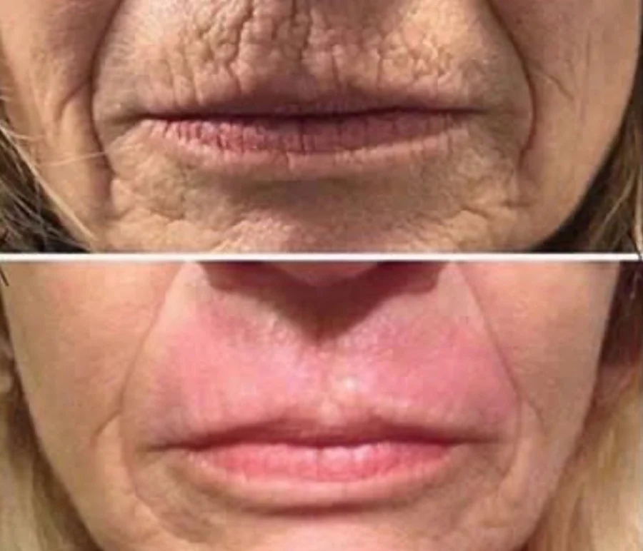 Before and after Plasma Fibroblast · Lip lines at Perfections Body Sculpt, Rowlett TX