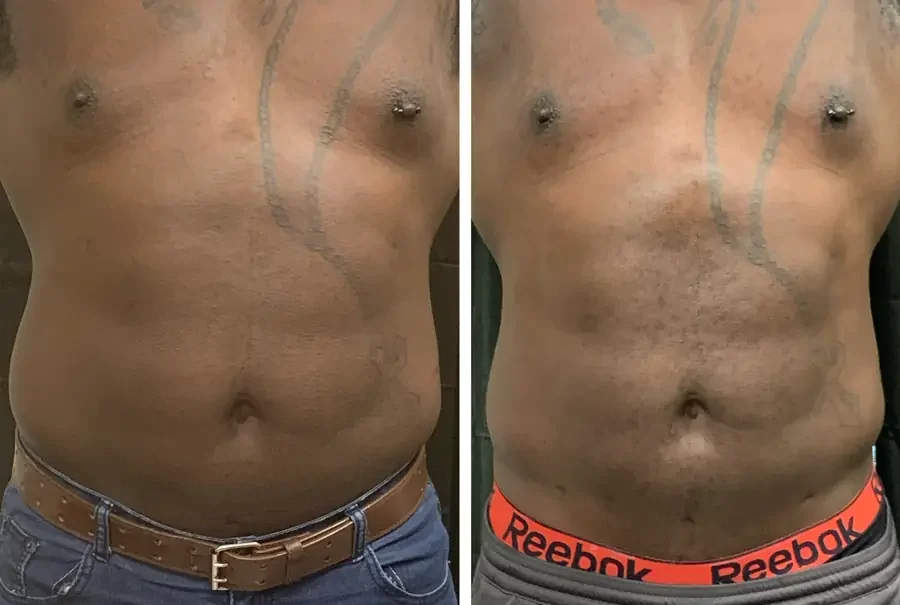 Before and after Laser Lipo at Perfections Body Sculpt, Rowlett TX
