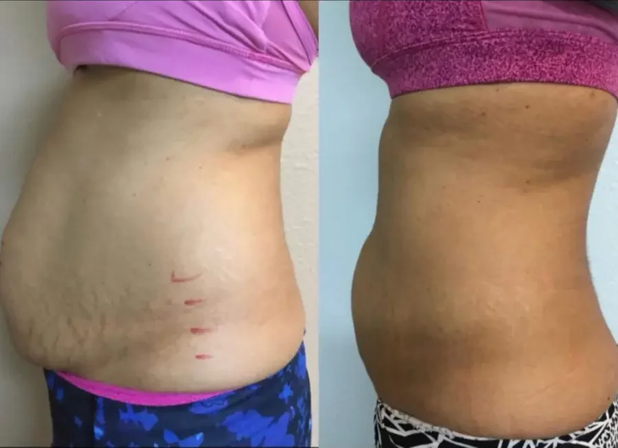Before and after Laser Lipo at Perfections Body Sculpt, Rowlett TX